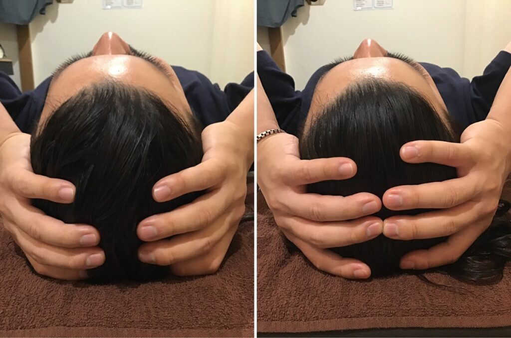 施術前後の頭部の写真 頭の施術前後