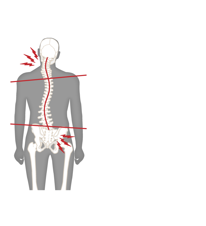 骨盤の歪みを赤線で記入したイラスト 骨盤や骨格が歪んだイラストと説明文