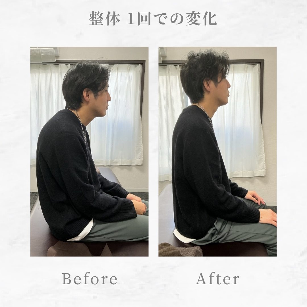 施術前後の姿勢の比較 施術前後の姿勢の変化